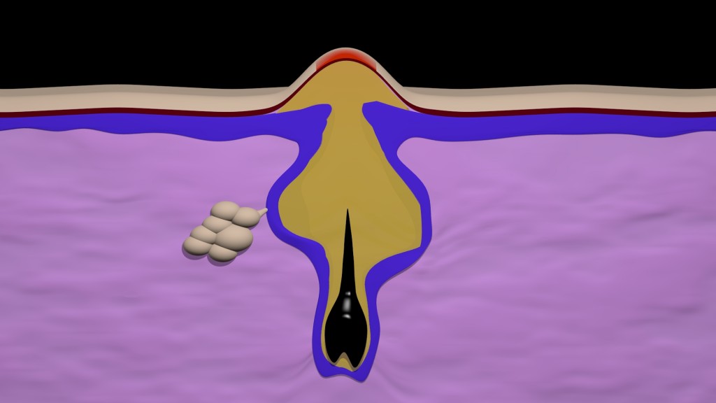 Acne formation preview image 1